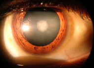 Eye_with_cataract